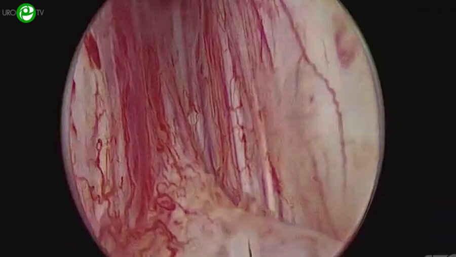 Дымов А.М. - Трансуретральная энуклеация простаты