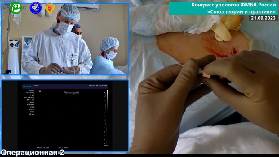 Данилов А.А. - ПНЛЛ под УЗИ-наведением