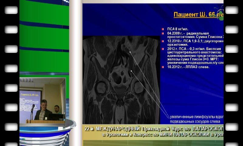 Владимир Сергеев "Повторные операции в онкоурологии открыто или лапароскопически"