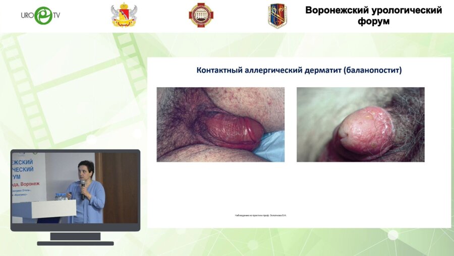 Шадёркина В.А. - Баланопостит - многоликий и междисциплинарный