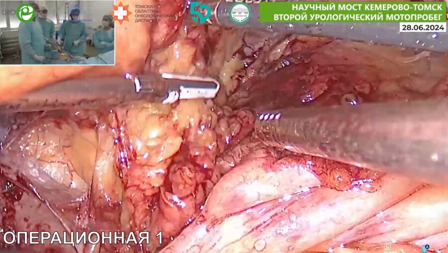 Комаров М.И. - Лапароскопическая простатэктомия