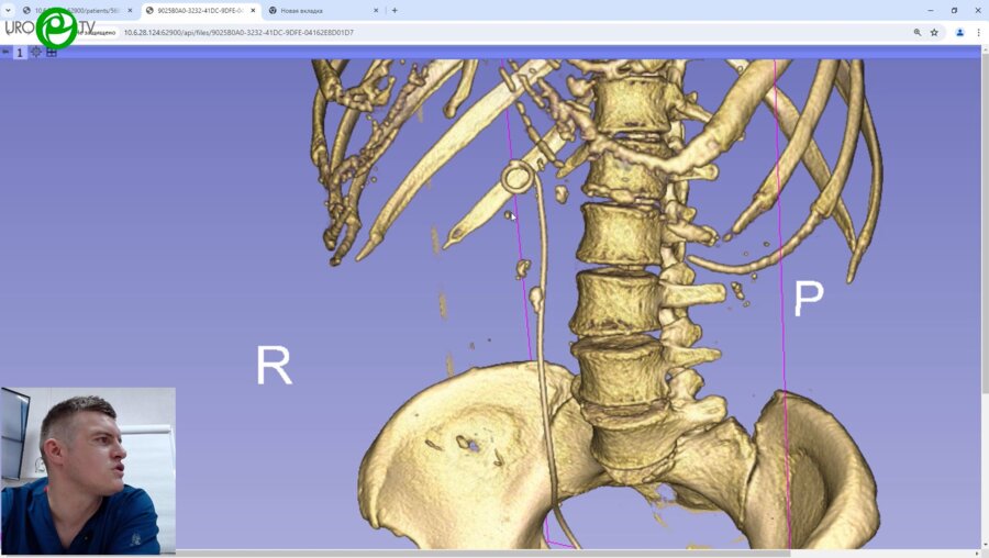 Уретрореноскопия справа. Трансуретральная контактная робот-ассистированная уретролитотрипсия справа