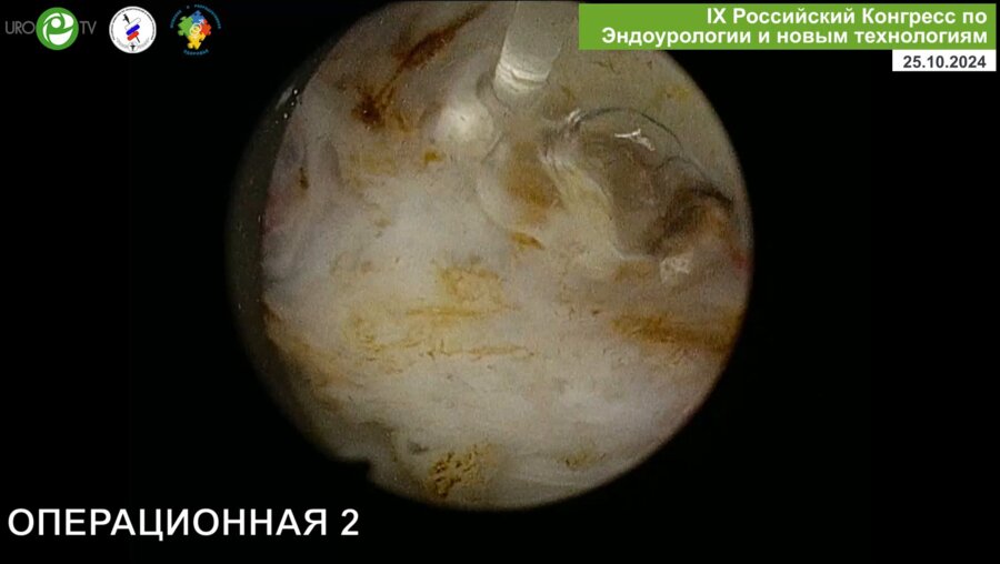 Бурлака О.О. - Лазерная энуклеация простаты