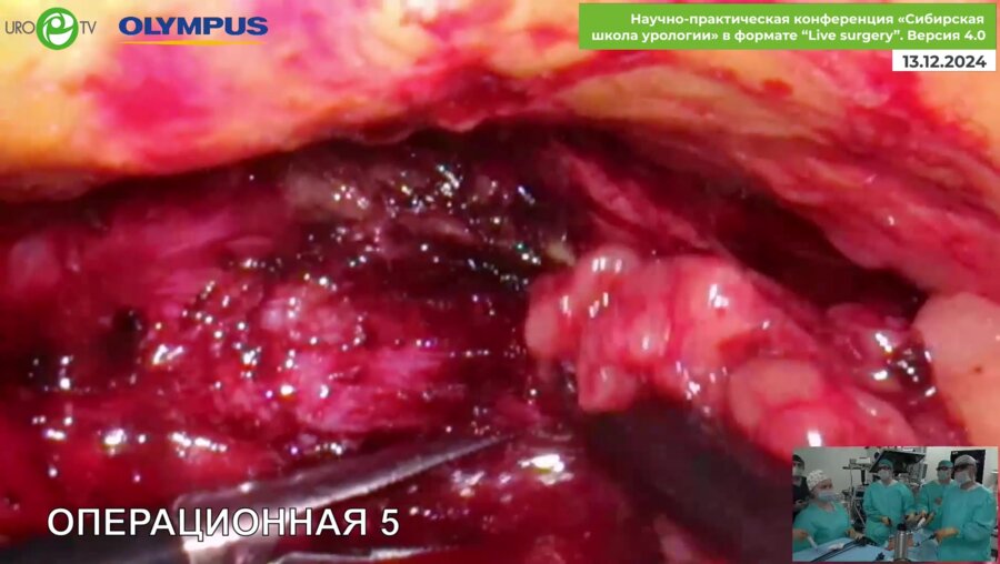 Помешкин Е.В. - Лапароскопическая аденомэктомия