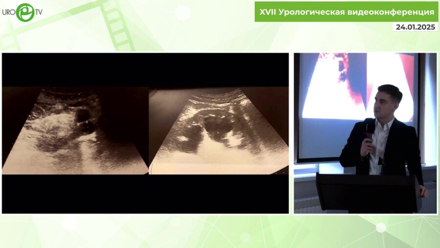 Лысёнок А.Ю. - Лапароскопический уретеронеоцистоанастамоз неполно удвоенной почки - клинический случай