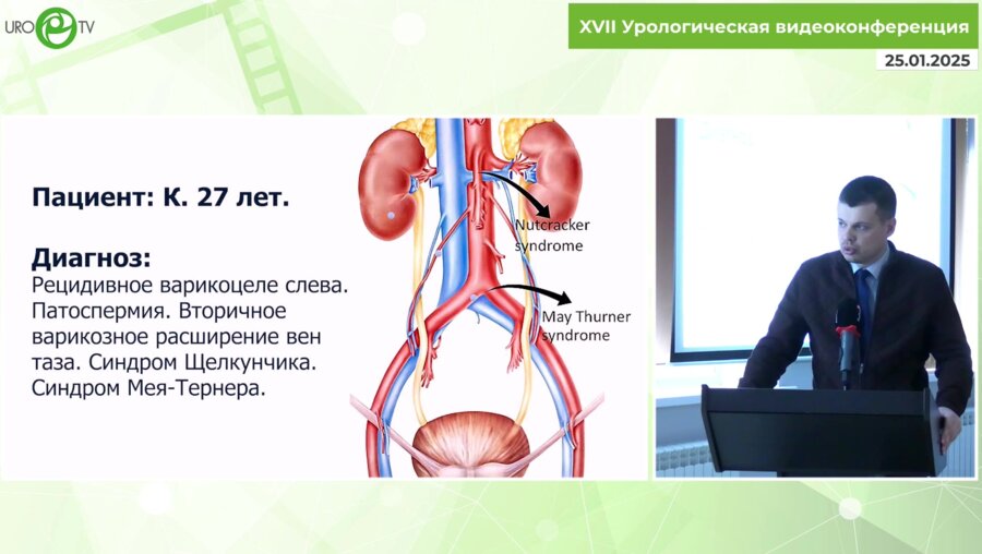Абоян И.А. - Робот-асисстированнася коррекция сосудистых конфликтов при рецидивном варикоцеле