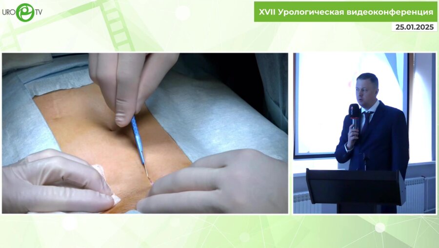 Пинчук И.С. - Коррекция недержания мочи у пациентов с континентной стомой