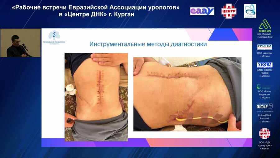 Безруков Е.А. - Лапароскопия и спаечный процесс в брюшной полости. Варианты преодоления осложнений