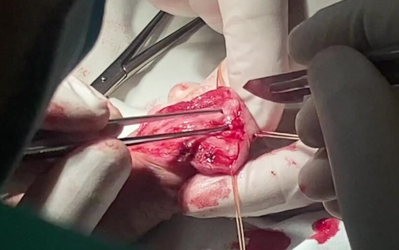 Т-образная пластика ладьевидной ямки уретры