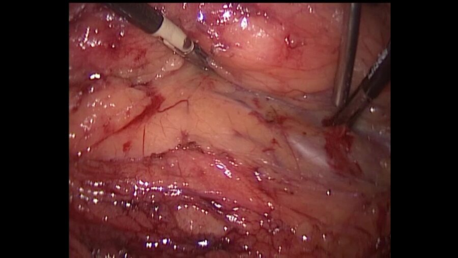 Лапароскопическая пиелолитотомия, каликолитоэкстракция, нефростомия, стентирование мочеточника