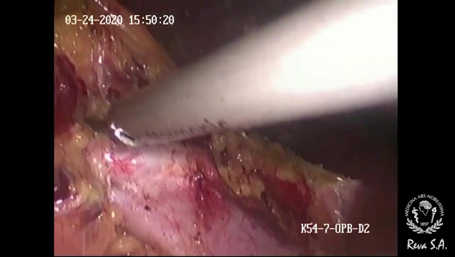 Лапароскопическая резекция множественных опухолей почки