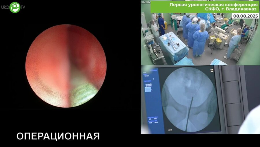 Маликиев И.Е., Горелов Д.С. - Ретроградная интраренальная хирургия HugeMed 7.5F
