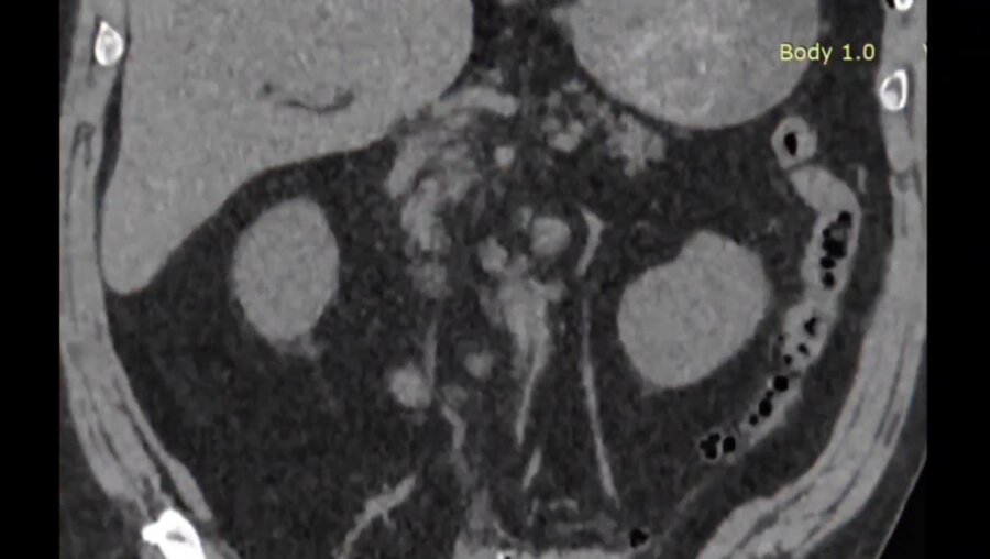 Безнефростомная супракостальная ПНЛ справа