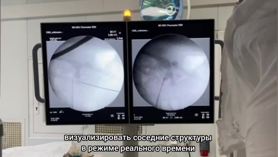 Коралловидный камень правой почки. Безнефростомная мини-ПНЛ