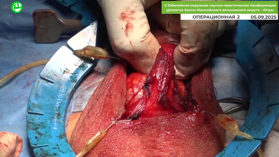 Сайидов Т.Н. - Фаллопротезирование однокомпонентным протезом