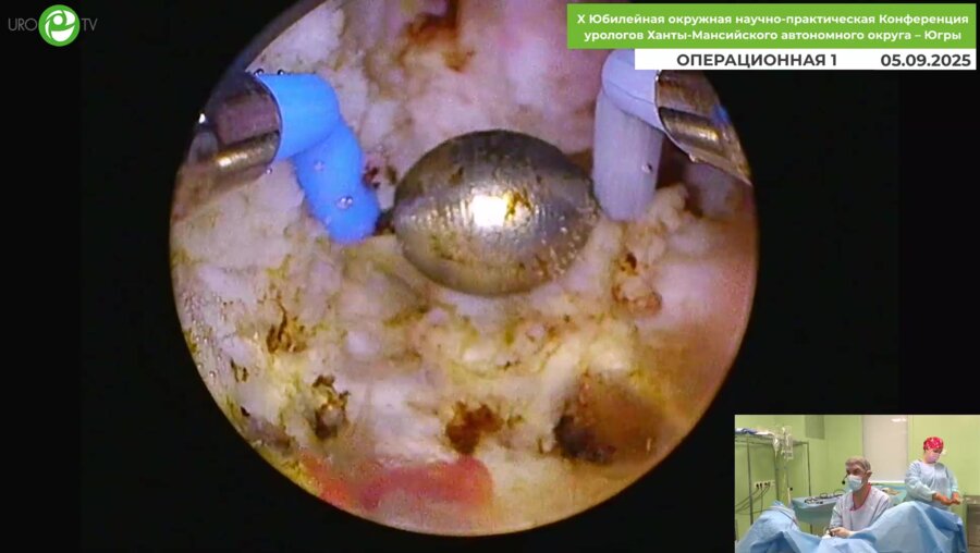 Дымов А.М. - Трансуретральная лазерная энуклеация гиперплазии простаты с применением туливого волоконного лазера