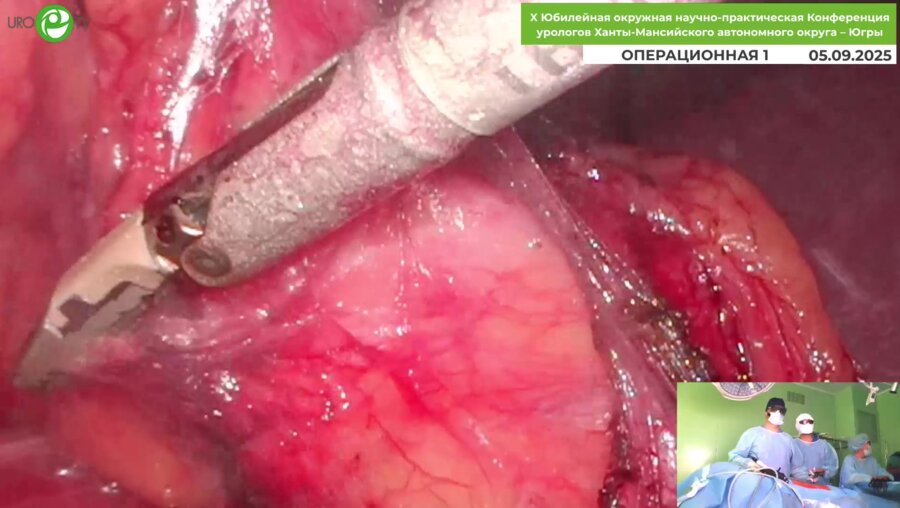 Орлов И.Н. - Olympus Visera 3D-лапароскопическая резекция мочеточника по поводу стриктуры лоханочно-мочеточникового сегмента