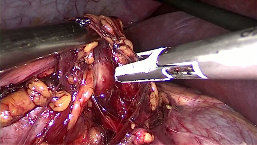 Опольский А.М. - Лапароскопическая антевазальная пластика пиелоуретерального сегмента справа