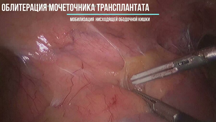 Пластика мочеточника трансплантата собственным мочеточником