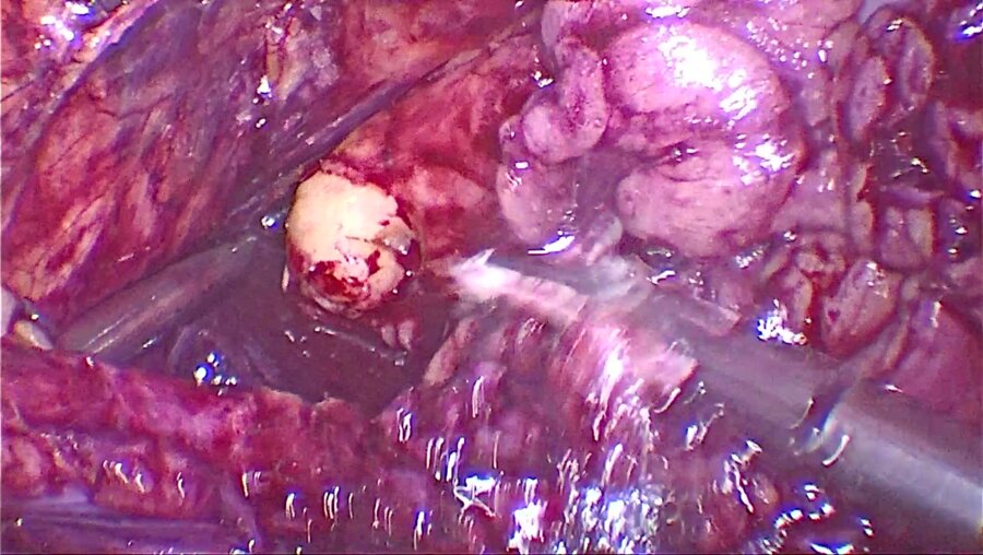 Кишечная пластика правого мочеточника