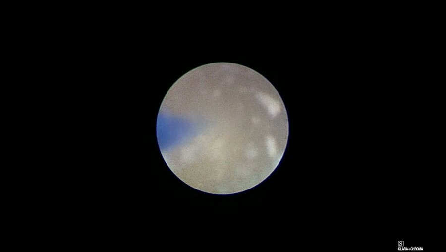 Ультрамини-перкутанная нефролитотрипсия с использованием аспирационного кожуха