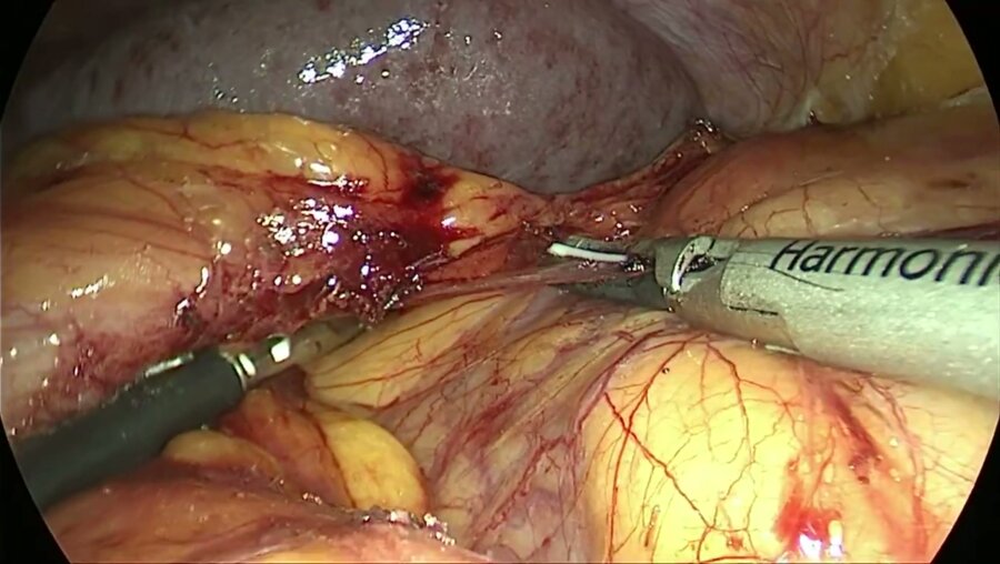Метастаз почечно-клеточного рака в контрлатеральный надпочечник. Адреналэктомия слева.