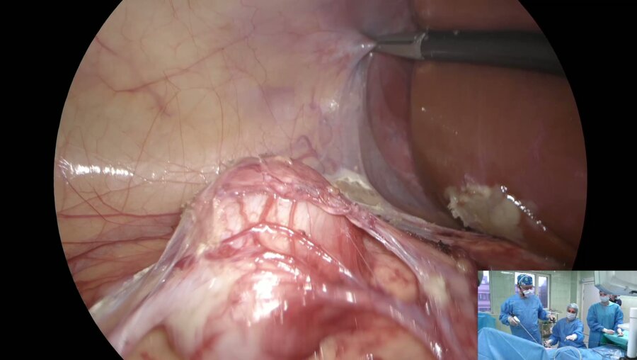 Врублевский С.Г. - Лапароскопическая геминефруретерэктомия