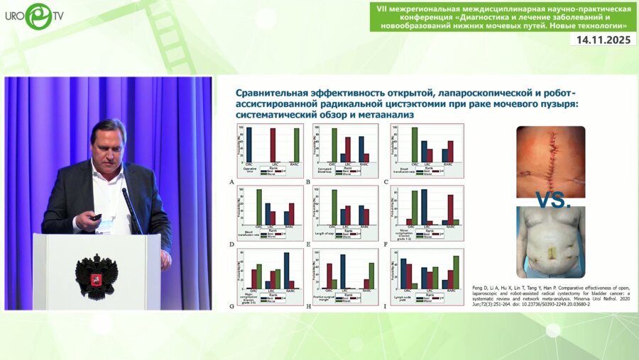 Грицкевич А.А. - Радикальная цистэктомия с использованием роботической техники. Опыт НМИЦ хирургии им. А.В. Вишневского