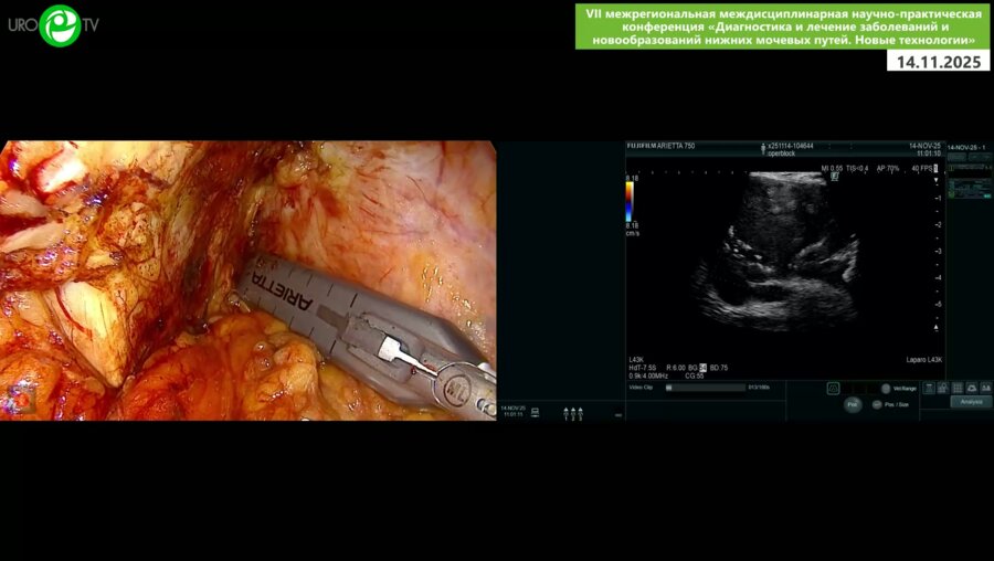 Кочкин А.Д. - Лапароскопическая аденомэктомия с ICG и УЗ–навигацией, цистолитотомия