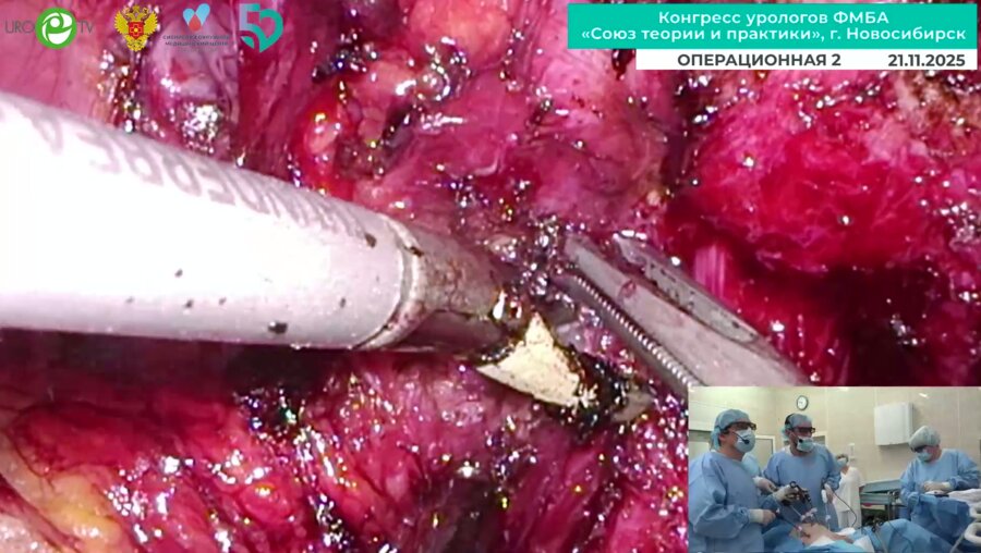 Володин Д.И., Сергеев В.П. - Лапароскопическая простатэктомия