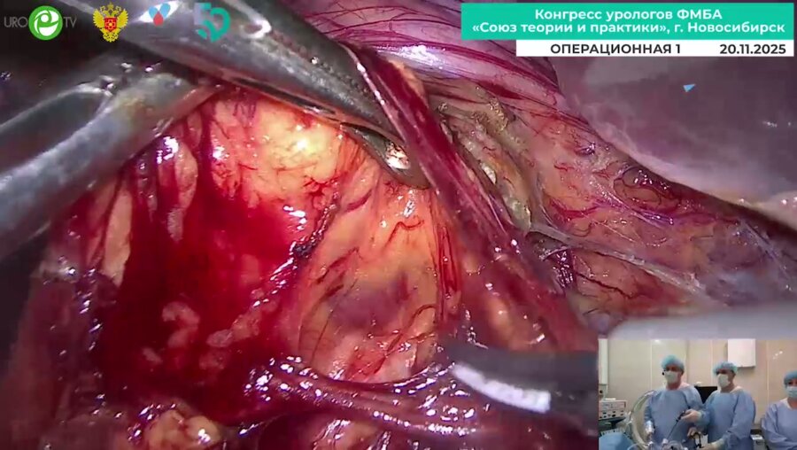 Санжаров А.Е.  - Лапароскопическая пластика пиелоуретерального сегмента