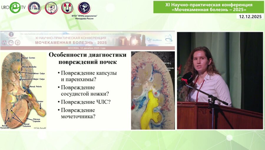 Телеш А.А. - Развитие мочекаменной болезни у пациентов с сочетанной боевой травмой живота c позиции лучевой диагностики