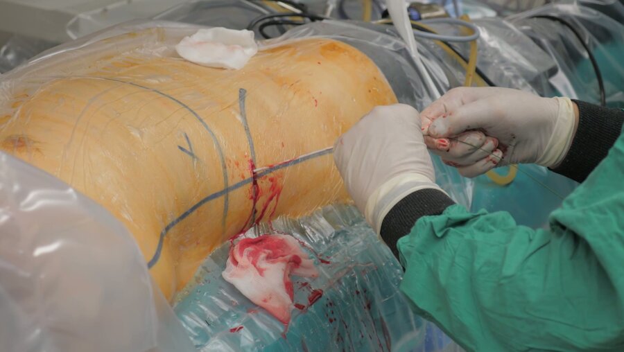 Мартов А.Г. - Миниперкутанная нефролитотрипсия с применением гольмиевого лазера CALCULASE III