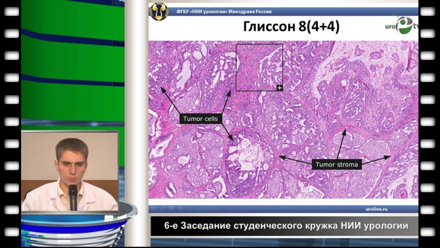 Просянников М.Ю. - Рак предстательной железы