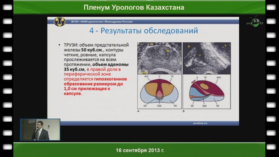Серебряный С.А. «Разбор клинического случая пациента с протяженной стриктурой (облитерацией) уретры»