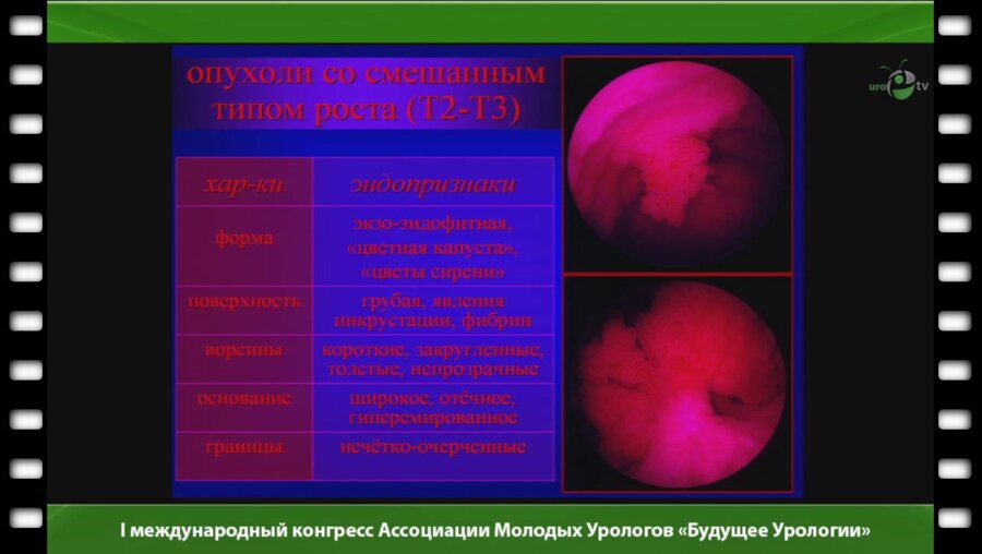 Мартов А.Г. - "Эндоскопические возможности диагностики рака мочевого пузыря"