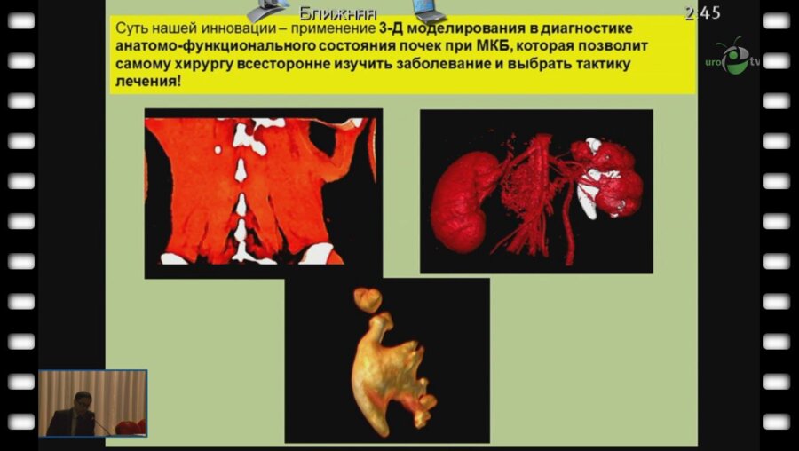 Глыбочко П.В. - "Новый подход к изучению анатомо-функционального состояния почек и выбору лечения при МКБ."