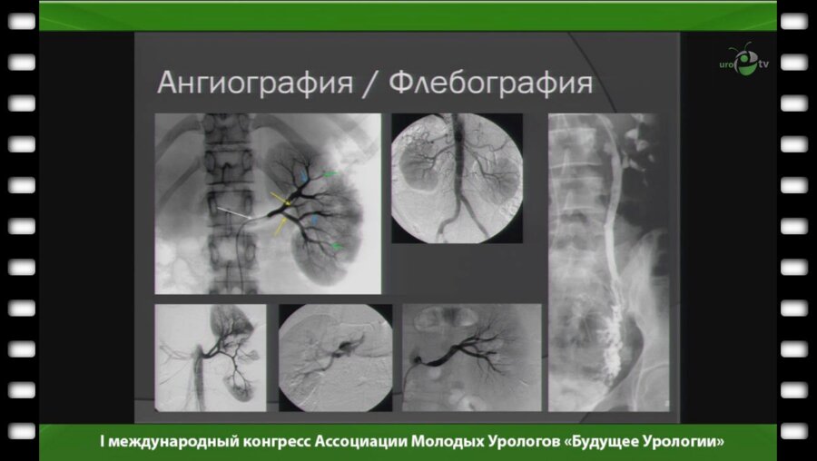 Волков С.В. - "Возможности эндоваскулярной хирургии в урологии"