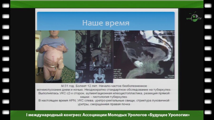 Холтобин Д. - "Цистопластика у больных туберкулезом мочевого пузыря"