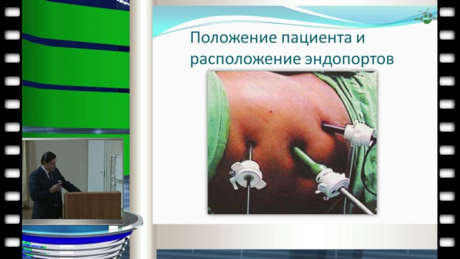 Аль-Шукри А.С. - "Наш опыт применения лапароскопического чрезбрызжеечного доступа при первичной и вторичной пиелопластике слева"