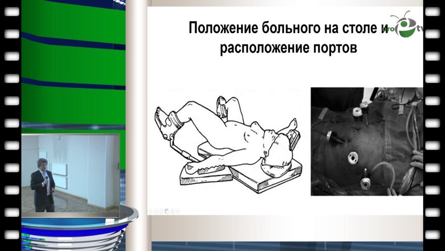 Петров С.Б. - "Первый опыт лапароскопических цистэктомий с интракорпоральным формированием илеокондуита в лечении рака мочевого пузыря"
