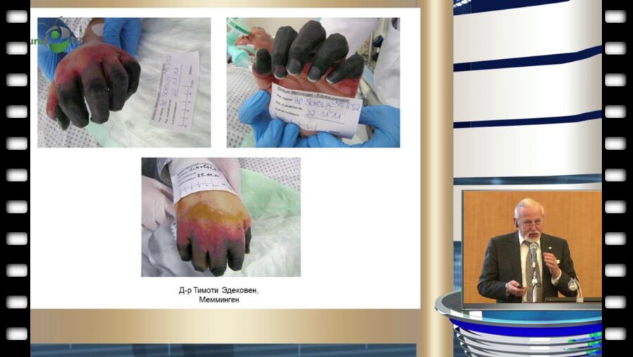 Johansen T. - "Инфекционные осложнения при биопсии простаты"