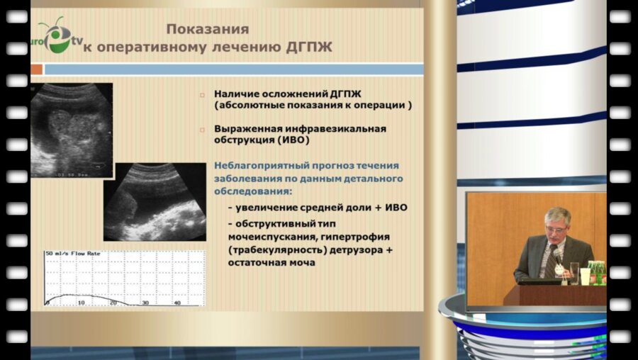 Сивков А. В. - "Эффективность силодозина у пациентов с выраженными симптомами нарушения функции нижних мочевых путей, обусловленными ДГПЖ"