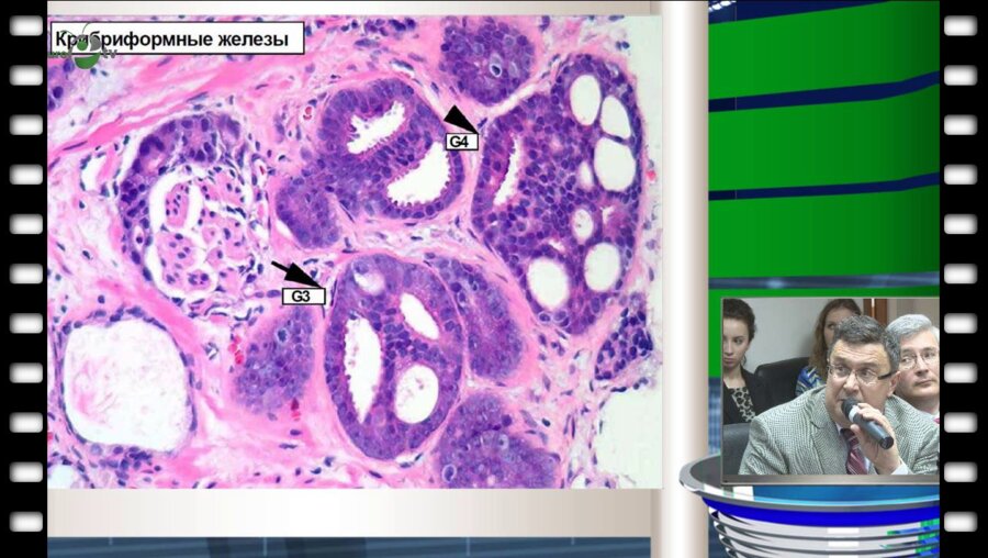 Ефремов Г.Д. - "Патоморфологические аспекты диагностики РПЖ"