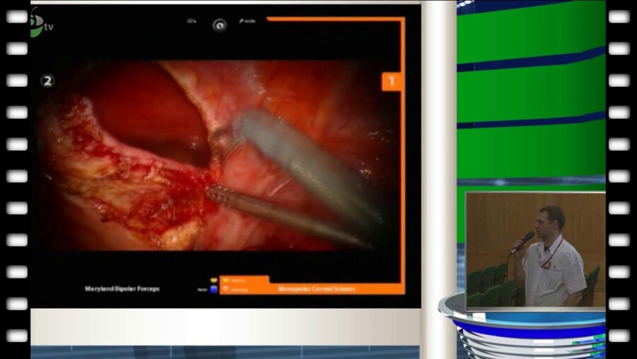 Новиков А. - Robot - assisted laparoscopic Boari flap ureterial reimplantation