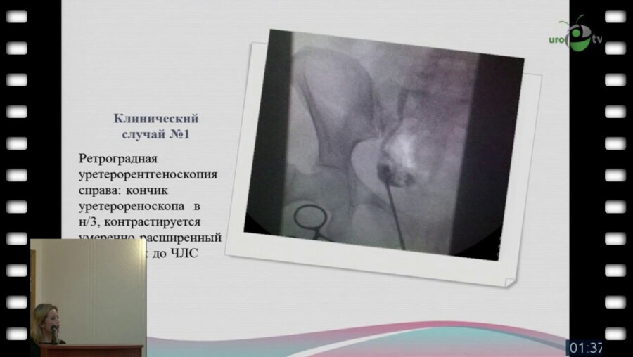 Анастасиевская Ю.Б. - "Эндоскопические методы в диагностике и лечении ятрогенных повреждений мочеточников"