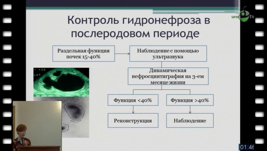 Задера Е.В. - "Лапороскапическая пиелопластика у детей"