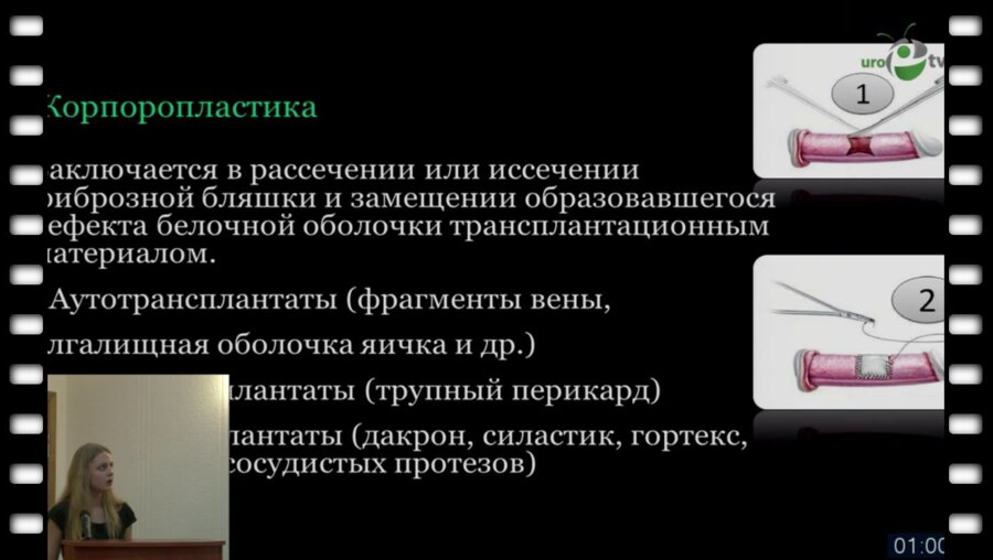 Оксенчук В.И. - "Хирургическое лечение болезни Пейрони"