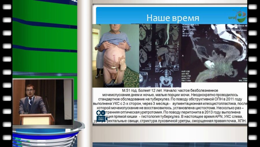 Д.П. Холтобин - Вопросы диагностики туберкулеза мочевого пузыря на амбулаторном приеме уролога