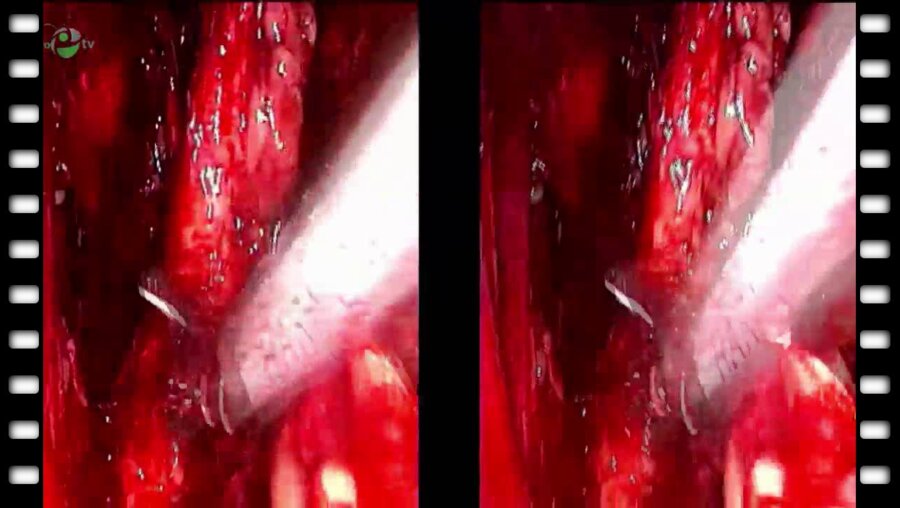 Видеоэндоскопическая экстрафасциальная радикальная простатэктомия. Тазовая лимфоаденэктомия (3D)